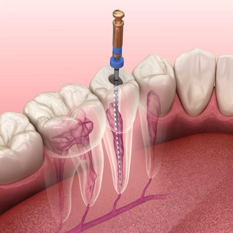 Root-Canal-Treatment-1