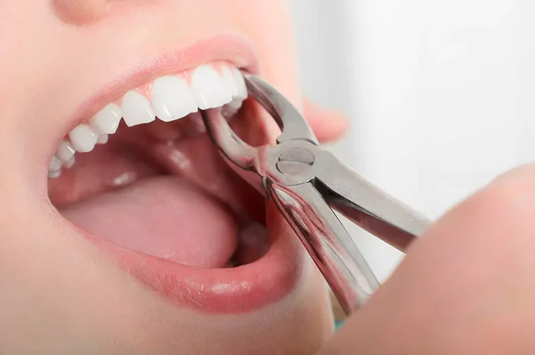 Tooth-Extraction