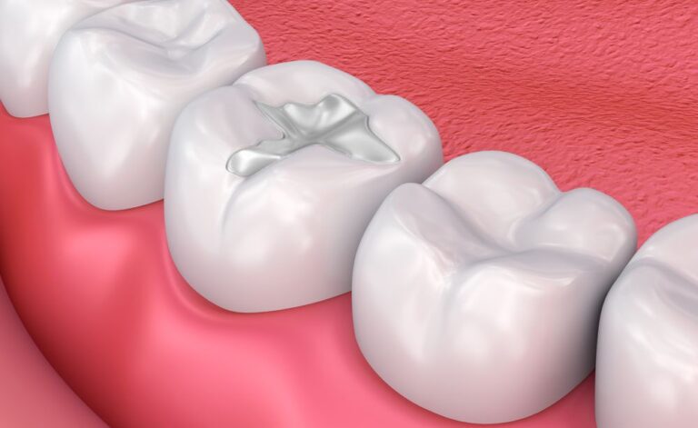 dental-fillings-newport-beach