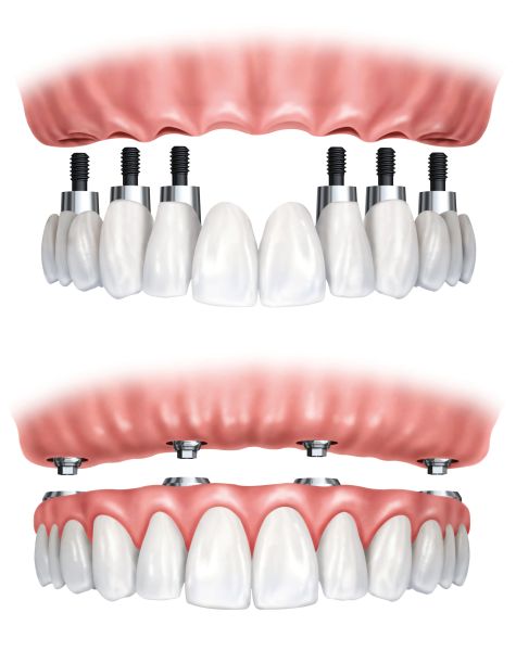 full-mouth-rehabilitation