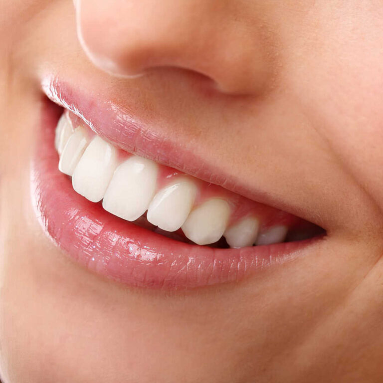 whiterockdental-teeth-whitening